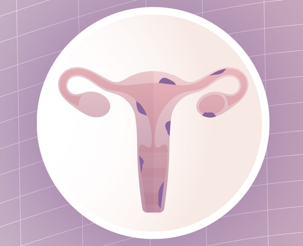 endometriose
