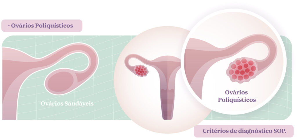 S ndrome De Ov rio Poliqu stico E Infertilidade Next Fertility s-ndrome-de-ov-rio-poliqu-stico-e-infertilidade-next-fertility