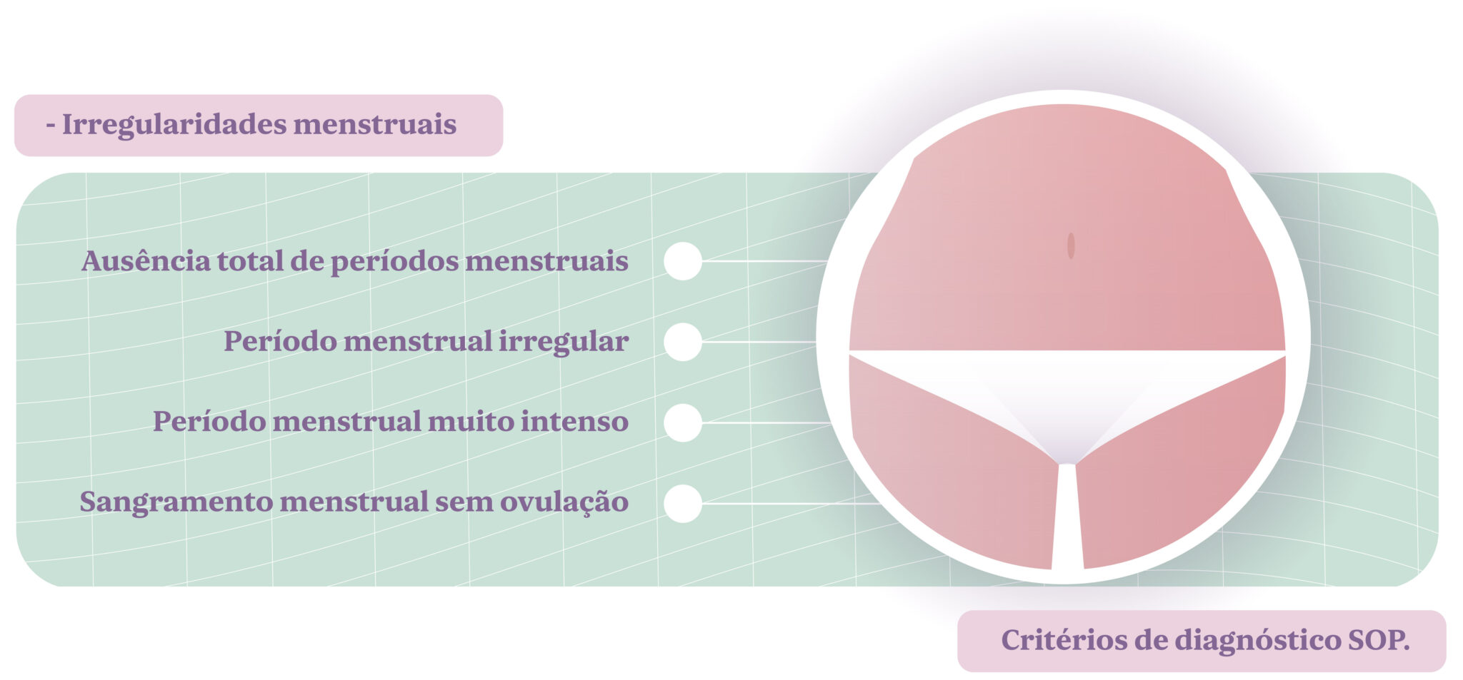 síndrome-de-ovário-poliquístico-irregularidades-menstruais