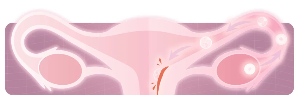 hemorragia-de-implantacao-ou-menstruacao-diferenças